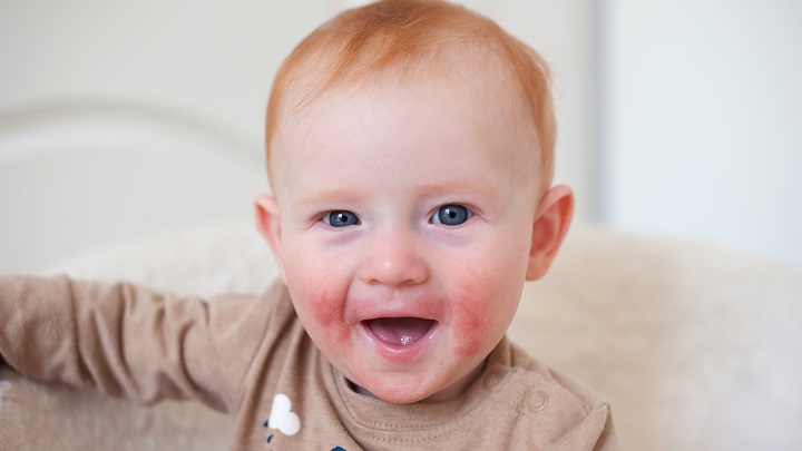 toddler with eczema